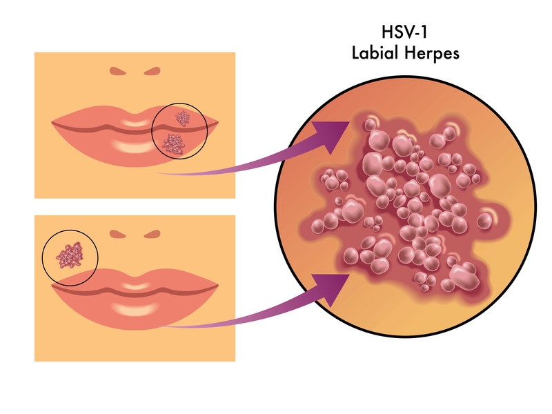 Herpes Oral Klinika Digjitale